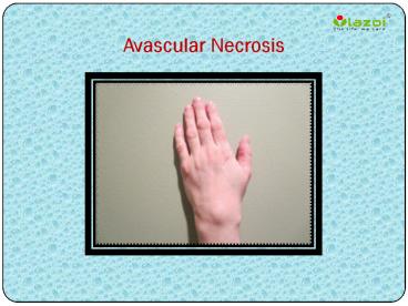 Avascular Necrosis: Causes, Symptoms, Diagnosis and Treatment (1)