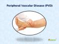 Peripheral Vascular Disease (PVD) - Causes, Symptoms, Diagnosis and Treatment (1) PowerPoint PPT Presentation