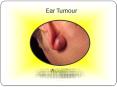 Watch Out? That ear pain may be a tumour (1) PowerPoint PPT Presentation