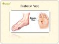 Diabetic Foot: Symptoms, Risks, Diagnosis, Treatment and Prevention (1) PowerPoint PPT Presentation