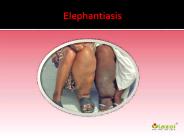 Elephantiasis: Causes, Symptoms and Treatment (1)