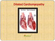 Dilated Cardiomyopathy (1)
