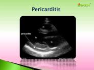 Pericarditis: Causes, Symptoms and Treatment (1)
