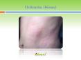 Urticaria (Hives): Symptoms, Causes, Diagnosis and Treatment (1) PowerPoint PPT Presentation