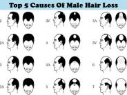 Top 5 Causes Of Male Hair Loss