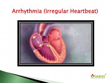 Arrhythmia (Irregular Heartbeat): Symptoms, Causes, Diagnosis and Treatment (1)