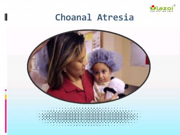 Choanal atresia: Symptoms, causes, diagnosis, treatment and prevention (1)