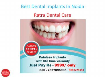 Best Dental Implants In Noida