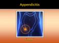 Appendicitis: Symptoms, causes, diagnosis and treatment (1) PowerPoint PPT Presentation