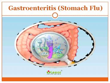 Gastroenteritis (Stomach Flu): Symptoms, causes, diagnosis and treatment (1)