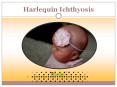 Harlequin Ichthyosis: Causes, symptoms, diagnosis and treatment (1) PowerPoint PPT Presentation