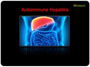 Autoimmune Hepatitis: Symptoms, causes and treatment (1)