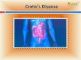 Crohn's Disease: Symptoms, Types, Causes Diagnosis and Treatment (1) PowerPoint PPT Presentation