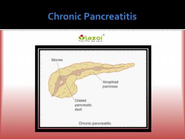 Chronic Pancreatitis: Causes, Symptoms, Diagnosis and Treatment of Chronic Pancreatitis (1)