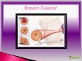 Breast Cancer : Overview of symptoms, causes, diagnosis, risk factor and treatment (1) PowerPoint PPT Presentation