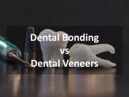 Difference Between Dental Bonding and Dental Veneers