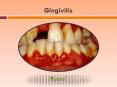 Gingivitis: Symptoms, Causes, Diagnosis and Treatment (1) PowerPoint PPT Presentation