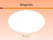 Gingivitis: Symptoms, Causes, Diagnosis and Treatment (1)