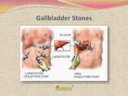 Gallbladder stones: Learn about symptoms, causes and treatment (1)