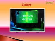 Goiter: Read about symptoms, causes and treatment (1)