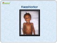 Kwashiorkor: A Protein Deficiency Disorder (1)