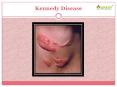 Kennedy disease: A study of symptoms, causes, diagnosis and treatment (1) PowerPoint PPT Presentation