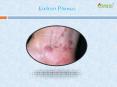 Lichen Planus: Symptoms, Causes, Diagnosis and Treatment (2) PowerPoint PPT Presentation
