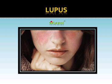 Lupus: Symptoms, Causes, Diagnosis and Treatment (1)