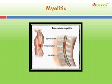 Myelitis : Overview, causes, types, symptoms, diagnosis and treatment (1)