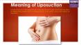 Liposuction in Delhi PowerPoint PPT Presentation
