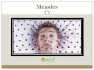 Measles: Causes, Symptoms, Complications and Treatment (1)