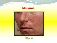 Melasma: Symptoms, causes and treatment (1)