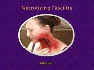 Necrotizing Fasciitis: Symptoms, Causes, Diagnosis and Treatment (1)
