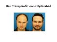 Hair Transplantation in Hyderabad | Hair Transplant Clinic Hyderabad PowerPoint PPT Presentation