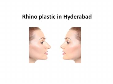 Rhinoplasty in Hyderabad | Rhinoplasty Cost in Hyderabad