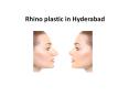 Rhinoplasty in Hyderabad | Rhinoplasty Cost in Hyderabad PowerPoint PPT Presentation