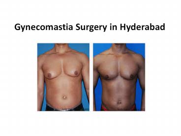 Gynecomastia Surgery in Hyderabad | Gynecomastia Cost Hyderabad