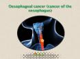 Oesophageal cancer (cancer of the oesophagus): Symptoms, Diagnosis and Treatment PowerPoint PPT Presentation