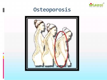 An overview of osteoporosis (1)