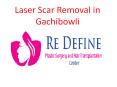 Laser Scar Removal in Gachibowli | Acne Scar Removal Treatment Gachibowli PowerPoint PPT Presentation