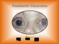 Why parents need to know extensively about childhood glaucoma (1) PowerPoint PPT Presentation