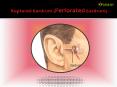 Ruptured Eardrum (Perforated Eardrum): A sneak peek (1) PowerPoint PPT Presentation