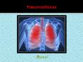 Pneumothorax: Symptoms, causes, diagnoses and treatment (1) PowerPoint PPT Presentation