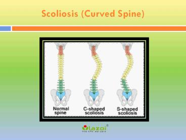 Scoliosis (Curved Spine): Symptoms, types, diagnosis and treatment (1)