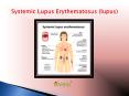 Systemic lupus erythematosus (lupus): Disease of the immune system (1) PowerPoint PPT Presentation