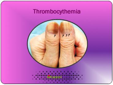 Thrombocythemia: Causes, Symptoms, Diagnosis, and Treatment (1)