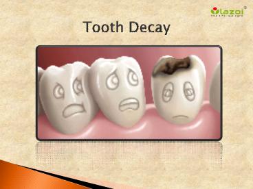 Tooth Decay: Symptoms, causes and treatment (1)