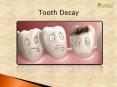 Tooth Decay: Symptoms, causes and treatment (1) PowerPoint PPT Presentation