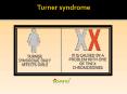 Turner syndrome: Symptoms, Causes, Treatment of Turner syndrome (1) PowerPoint PPT Presentation