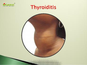 Thyroiditis: A clinical in-sight (1)